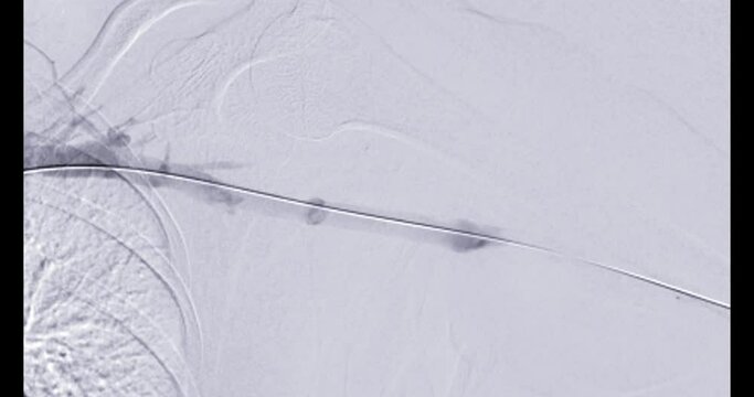 Angioplasty, balloon angioplasty and percutaneous transluminal angioplasty (PTA)  for dialation vessel.