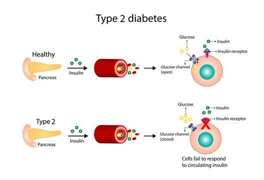Diabetes mellitus type 2, cells fail to respond to insulin (Insulin resistance). high blood glucose levels. Vector Diagram illustration.