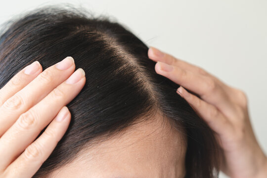close up on hair of people have a dandruff on the head