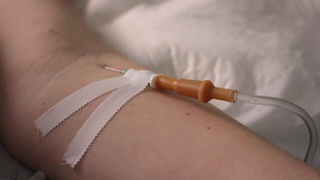 The needle of a medical dropper is out of focus in the vein of the arm, elbow. The process of injecting drugs intravenously. Pain relief after surgery. Close-up. High quality 4k footage