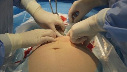 Opening of the fetal bladder during caesarean section. The hands of medical workers are out of...