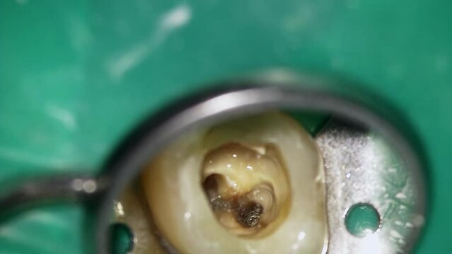 Dentist is fulling hole in tooth with water to clean cavity from bacterium filmed in macro. Doctor treats destroyed by caries molar using professional tools. Taking care of teeth. Bad oral hygiene