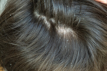 Dandruff in kid hair. Flaky scalp. Children's dandruff. Seborrheic dermatitis. White scales on the scalp and on the hair