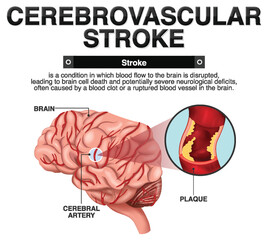 Informative poster of Cerebrovascular stroke