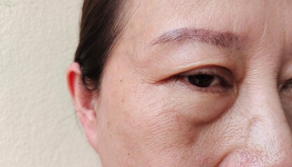 Obraz premium portrait showing the flabbiness adipose hanging skin, wrinkle and Inflammation skin on the face, ptosis and flabby skin beside the eyelid, cosmetic and beauty concept.