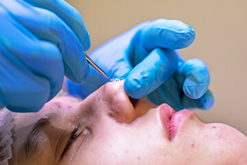 cosmetologist removes black dots from the nose with a special tool.