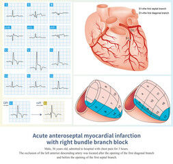 Counterclockwise rotation is a common ECG phenomenon, which is partly a simple ECG phenomenon, and partly related to left ventricular hypertrophy caused by disease.