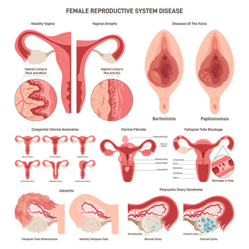 Female reproductive system disorder set. External and internal organs