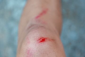 First aid and injuries concept, A man showing a little bit lesion, Accident wound or abrasion marks...
