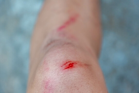 First aid and injuries concept, A man showing a little bit lesion, Accident wound or abrasion marks on the left side knee, Healthcare and medical background.