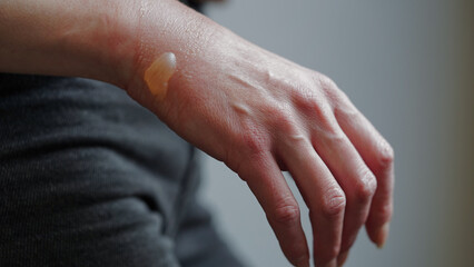 Close-up of a woman's hand with a blister from a boiled water burn, damaged skin, 1st or second...