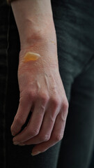 Close-up of a woman's hand with a blister from a boiled water burn, damaged skin, 1st or second...