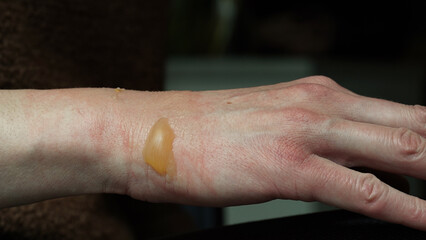 Close-up of a woman's hand with a blister from a boiled water burn, damaged skin, 1st or second...
