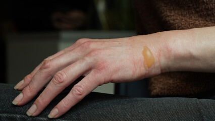 Close-up of a woman's hand with a blister from a boiled water burn, damaged skin, 1st or second degree burn. Painful wound. Thermal burn. Water bladder from a burn, wound treatment.Macro photo