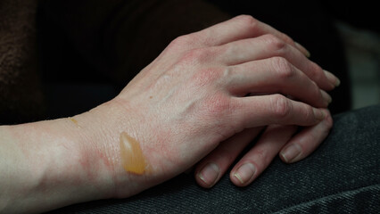 Close-up of a woman's hand with a blister from a boiled water burn, damaged skin, 1st or second degree burn. Painful wound. Thermal burn. Water bladder from a burn, wound treatment.Macro photo