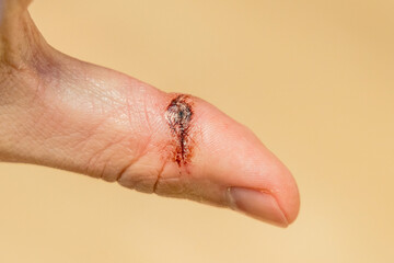 Closeup of accidental knife cut on the skin of a finger. Bleeding blood from injured finger