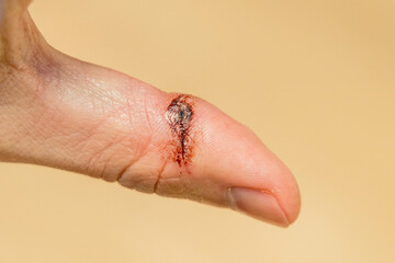 Closeup of accidental knife cut on the skin of a finger. Bleeding blood from injured finger
