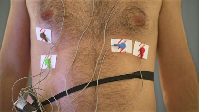 Close up electronic machine holter with lots of wires and medical electrodes monitors vital signs of patient. ECG, congenital heart defect diagnostic, aortic valve, cardiology, health care