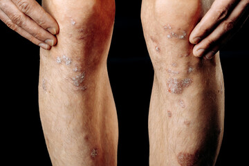 Acute psoriasis on the legs is an autoimmune incurable dermatological skin disease. A large red, inflamed, scaly rash on the knees. Joints affected by psoriatic arthritis 