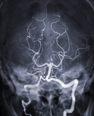 Cerebral angiography  imageor potesterior cerebral artery from Fluoroscopy in intervention...