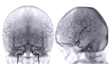 Cerebral angiography  image from Fluoroscopy in intervention radiology  showing cerebral artery.