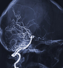 Cerebral angiography  image from Fluoroscopy in intervention radiology  showing cerebral artery.