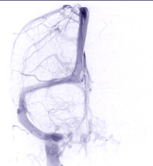 Cerebral  Venograpgy for diagnosisi Cerebral Venous Thrombosis