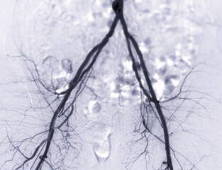 Femoral artery angiogram or angiography - obrazy, fototapety, plakaty
