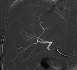 Imaging of TACE or Chemoembolization is a procedure that allows a dose of chemotherapy drugs to be administered directly to Liver tumor or HCC showing hepatic artery.