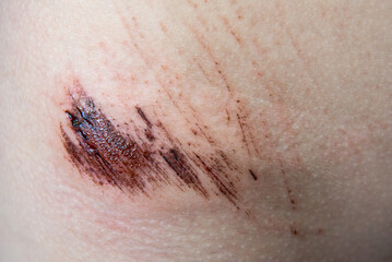 Close-up of a wound on the child's skin, skin pain, patient