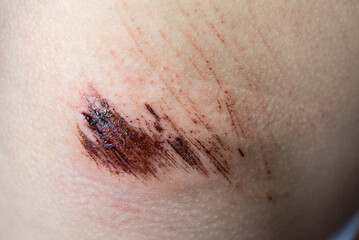 Close-up of a wound on the child's skin, skin pain, patient