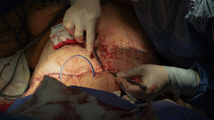 tummy tuck surgery. Doctor performs tummy tuck surgery with cautery