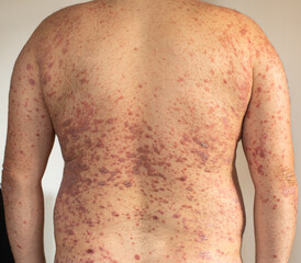 A man with psoriasis