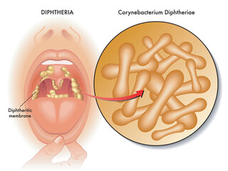 Medical illustration of symptoms of diphtheria, with annotations. 