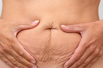 Hands on belly pressed skin to show sagging skin after diet and stretch marks after pregnancy - obrazy, fototapety, plakaty