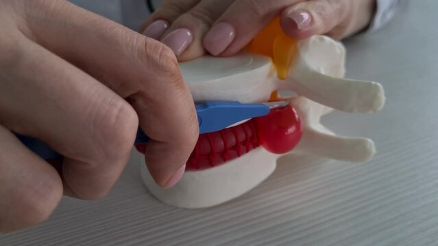 Surgeon shows intervertebral hernia on model to patient concept