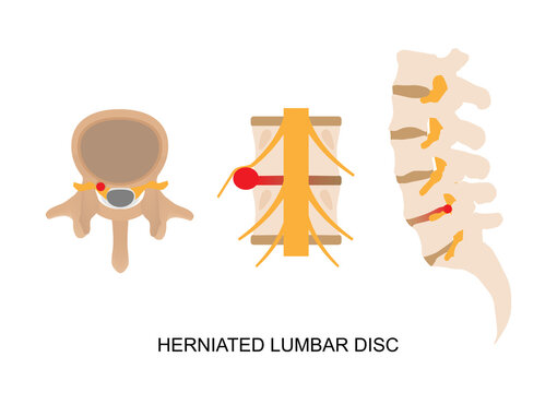 Diagnosing a Lumbar Herniated Disc