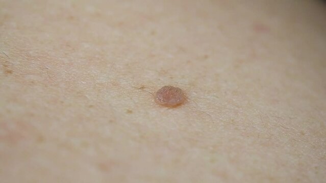 Mole birthmark nevus macro on human skin. crochordon or soft fibroma close up. dermatology problem skin concept
