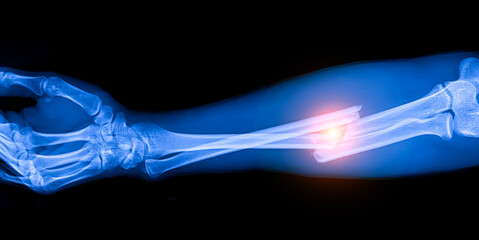 Blue tone radiograph on background in hospital. The doctor used an xray for diagnosis. Forearm...