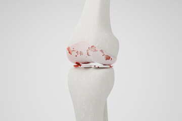 Knee osteoarthritis isolated white background 3D rendering.