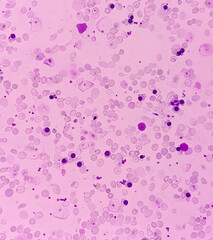 Hereditary hemolytic anemia. Hemoglobin E (HbE) disease. Smear show 90 nRBC100 wbc, pencil cell,...