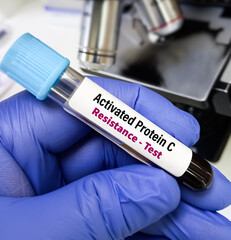 Blood sample for APCR(Activated protein C resistance) test. Screening test for factor V Leiden gene...
