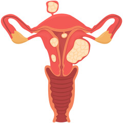 Uterine fibroids, myoma, uterine leiomyomas in reproductive system png 