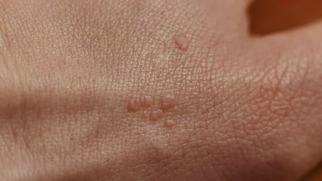 Close up examination of a wart on the patient's hands with a dermatoscope magnifying glass before laser removal. Exam of warts and papillomas on hands, cure and treatment. One day surgery concept.