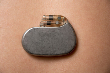 pacemaker on the skin surface