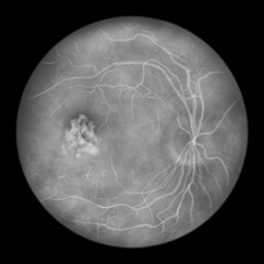 Best vitelliform macular dystrophy, Vitelleruptive stage, scrambled egg appearance, illustration, fluorescein angiography