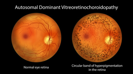 Autosomal dominant vitreoretinochoroidopathy, illustration showing normal eye retina and retina with circular band of hyperpigmentation