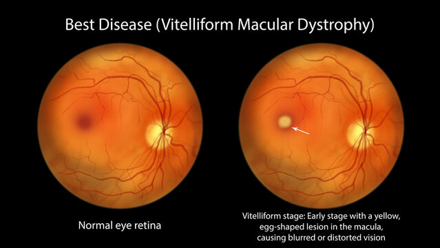 Best disease, illustration showing normal eye retina and Best vitelliform macular dystrophy, vitelliform stage with classic egg-yolk lesion