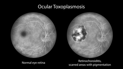 Retinal scar caused by a Toxoplasma gondii infection, or toxoplasmosis, and the same healthy eye retina for comparison, scientific illustration