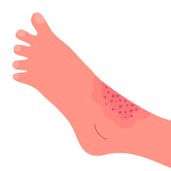 Dermatitis on the skin of a human leg. Dermatological disease. The symptom is itching, pain, redness and rash. Allergic reaction. Medical diagnostics and treatment. Vector illustration